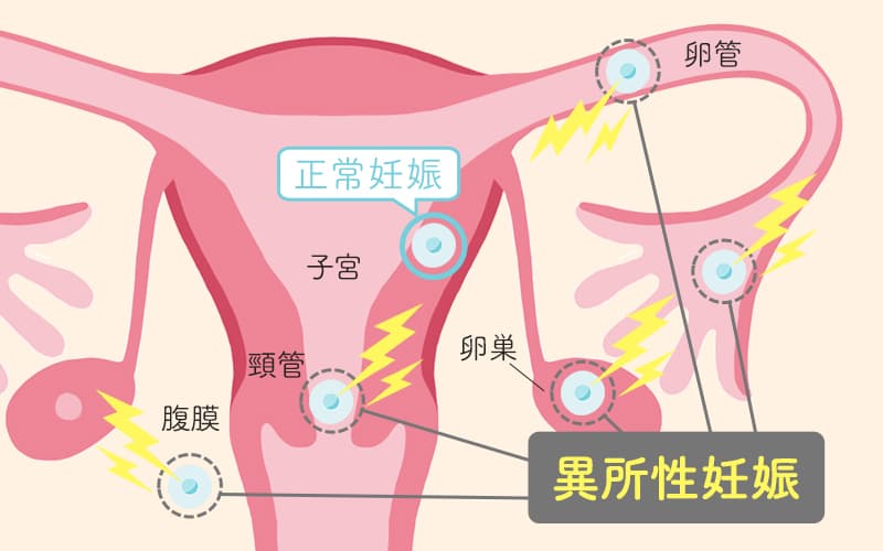 異所性妊娠とは、子宮内膜ではない場所に着床すること。母体の命にもかかわる危険な妊娠です。