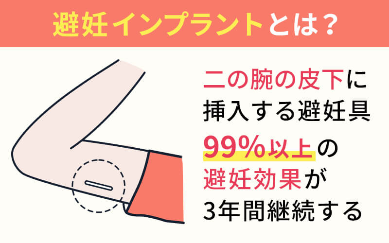 避妊インプラントとは