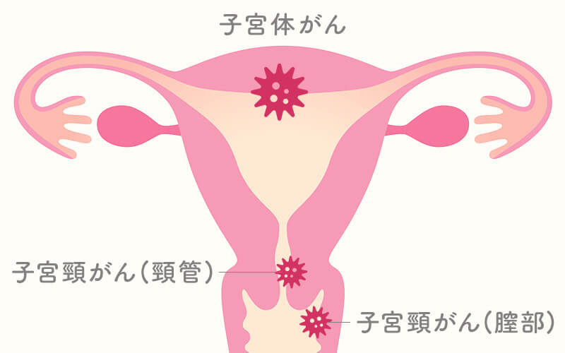 子宮体がん検診とは